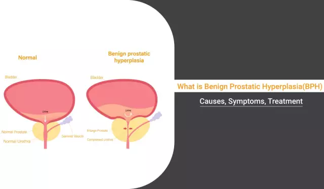 Benign Prostatic Hyperplasia