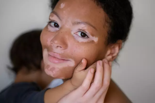 Vitiligo - Causes, Treatment Methods