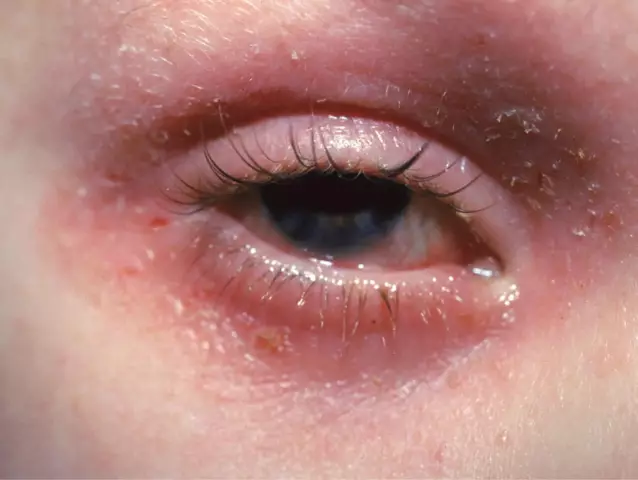 Inflammation Of The Eyelid - Symptoms, Treatment And Prevention