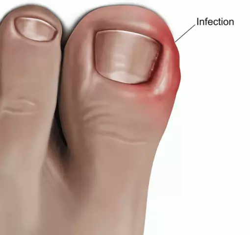 Ingrown Nail - Causes, Treatment At Home, Surgery, Reviews