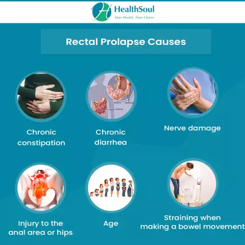 Rectal Prolapse - Treatment, Causes, Symptoms