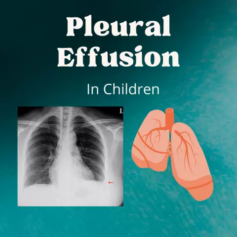 Effusion - Types, Causes, Treatment, Diagnosis