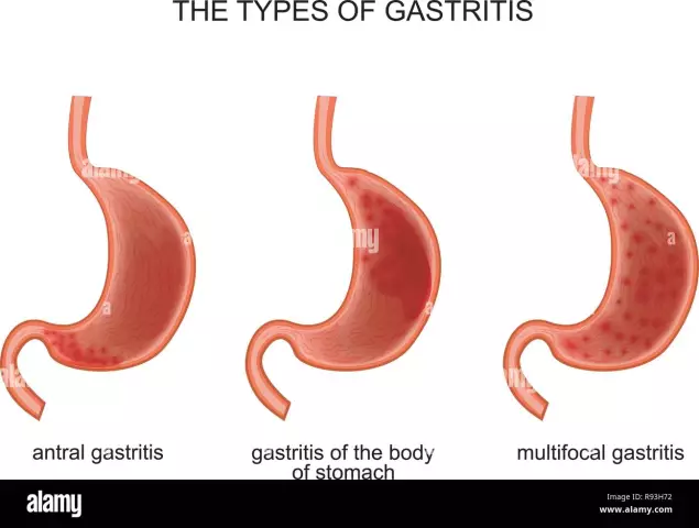 Gastritis - Types, Symptoms, Treatment, Diet