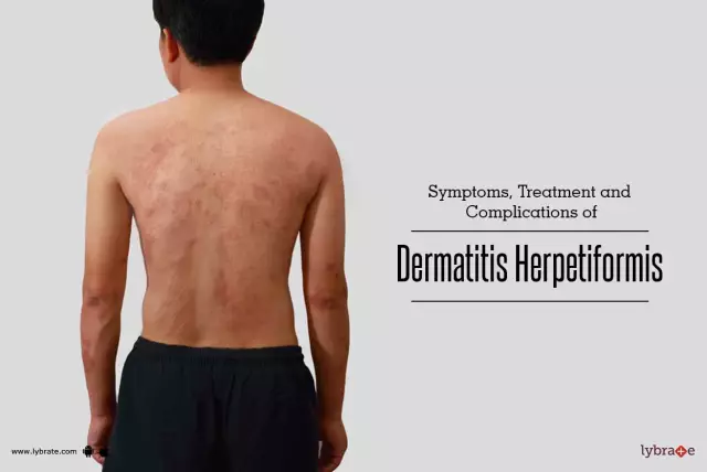 Dühring's Dermatitis Herpetiformis - Symptoms, Treatment