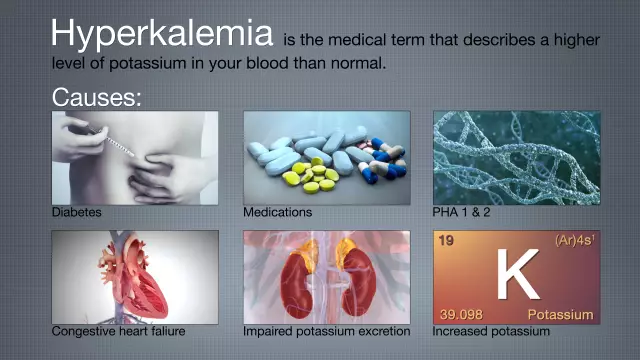 Hyperkalemia - Symptoms, Causes, Treatment