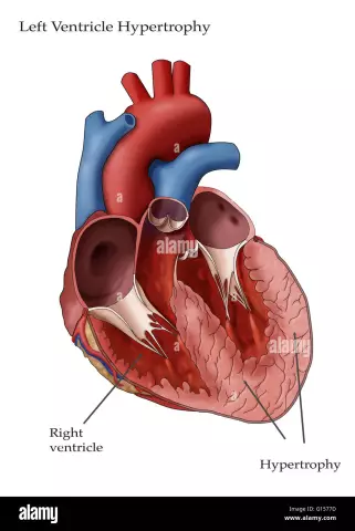 Left Ventricular Hypertrophy - Treatment, Signs