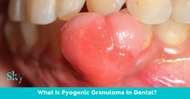 Tooth Granuloma - Causes, Symptoms, Treatment