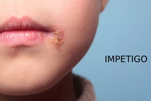 Impetigo In Children And Adults - Symptoms, Treatment Methods