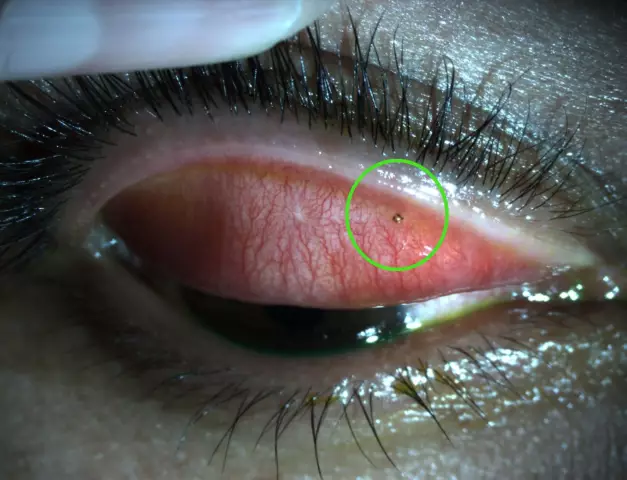 Foreign Body In The Eye - Sensation, Entry, Removal