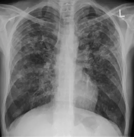 Miliary Tuberculosis - Causes, Symptoms, Diagnosis