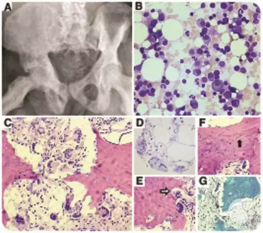 Myeloma - Symptoms, Treatment, Prognosis