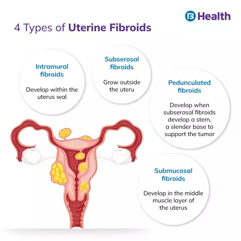 Uterine Fibroids - Treatment, Symptoms, Causes