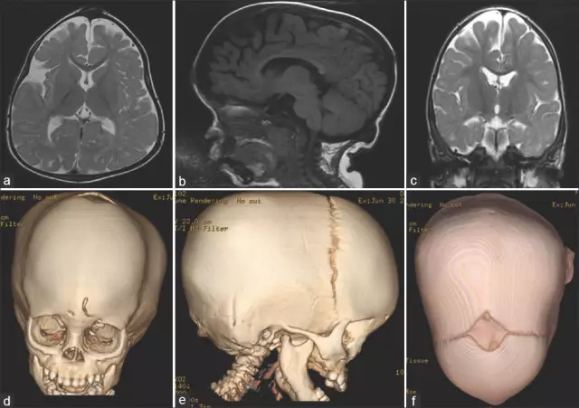 Mucopolysaccharidosis - Types, Symptoms, Treatment