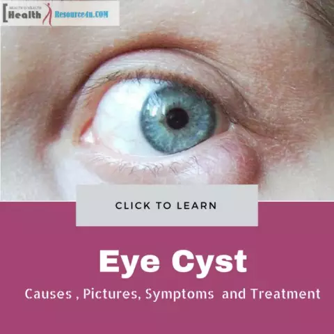 Eye Cyst - Causes, Symptoms, Treatment Methods, Removal