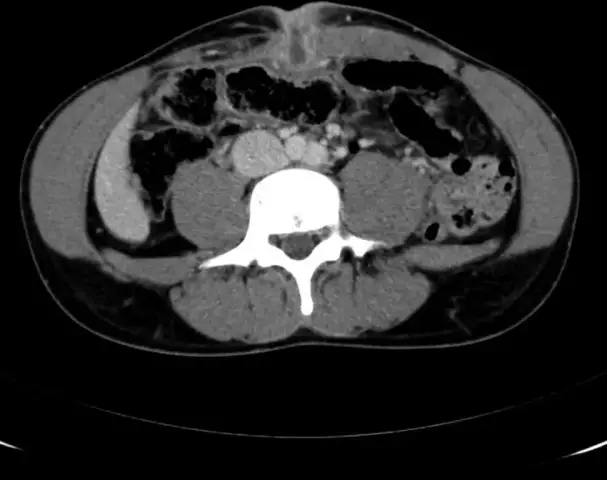 Urachus Cyst - Symptoms, Diagnosis, Treatment