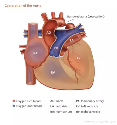 Coarctation Of The Aorta - Treatment, Surgery, Symptoms