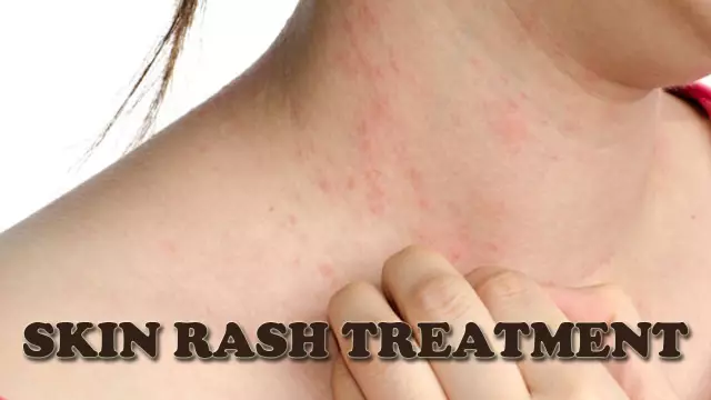 Skin Rash - Types, Treatment