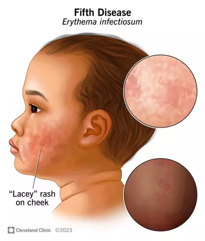 Ring-shaped Erythema - Causes, Symptoms, Treatment