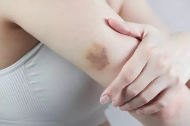 Contusion - Treatment, Symptoms, Consequences, Causes