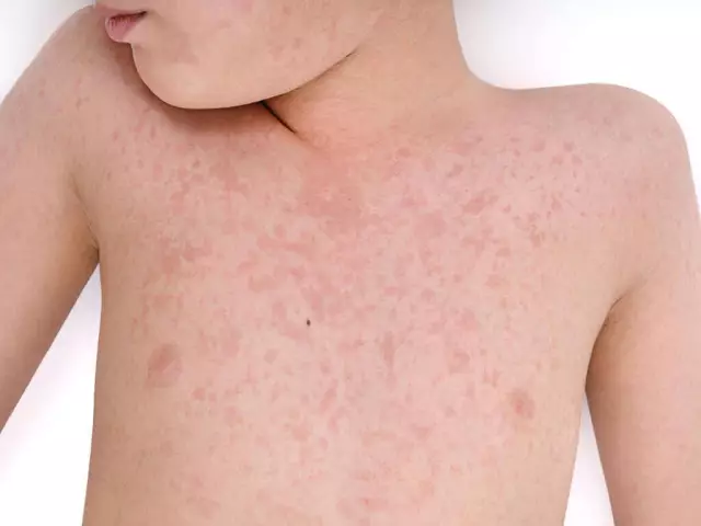 Rubella - Symptoms, Types, Treatment