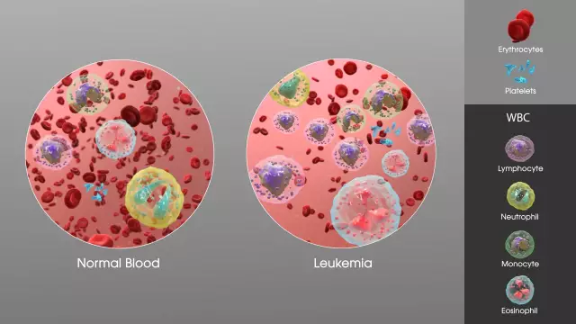 Leukemia - Symptoms, Treatment, Causes