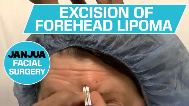 Lipoma - Removal, Alternative Treatment, Symptoms