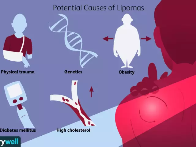 Lipoma Of The Breast - Symptoms, Diagnosis, Treatment