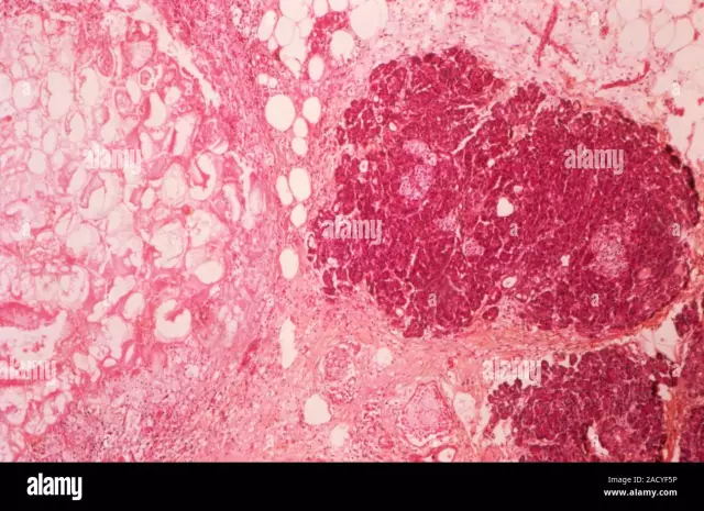 Pancreatic Necrosis Of The Pancreas - Surgery, Treatment