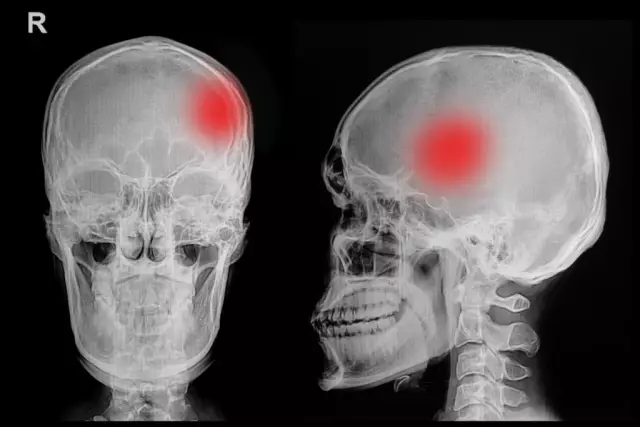 Fracture Of The Base Of The Skull - Symptoms, Treatment, Consequences