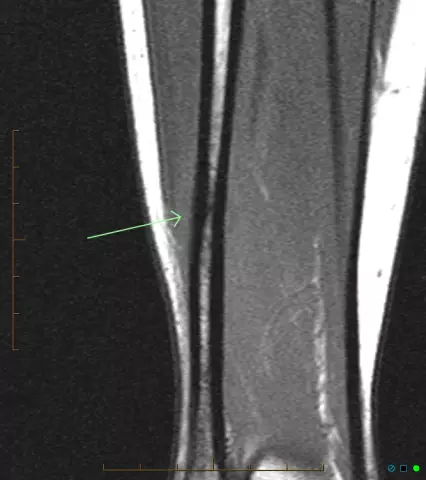 Fracture Of The Fibula - Symptoms, Diagnosis, Treatment