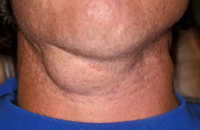 Submandibular Lymphadenitis - Symptoms, Treatment, Causes