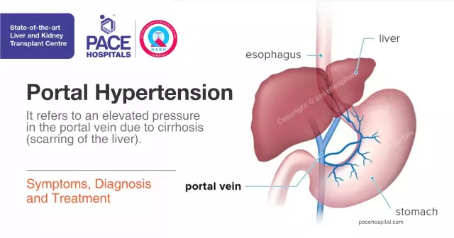 Portal Hypertension - Etiology, Symptoms, Diagnosis, Treatment