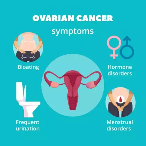 Ovarian Cancer - Symptoms, Treatment, Metastases