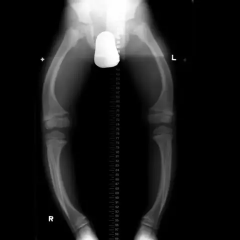 Rickets - Signs, Symptoms And Treatment