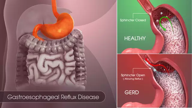 Reflux Esophagitis - Symptoms, Treatment, Diet