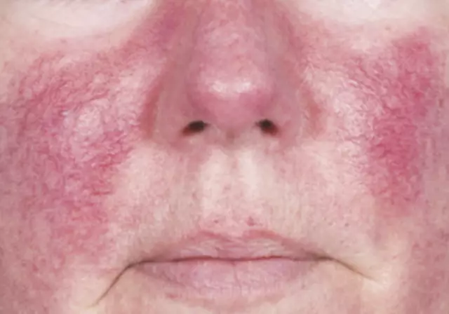 Rosacea - Symptoms And Treatment With Folk Remedies