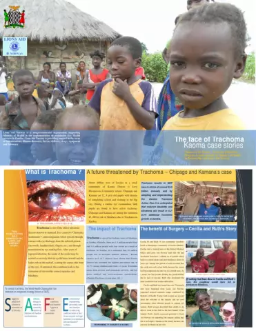 Trachoma - Stages, Symptoms, Treatment