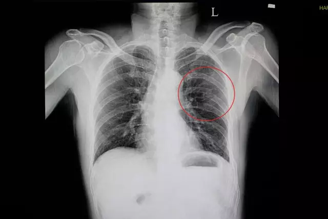 Cracked Rib - Symptoms, Treatment