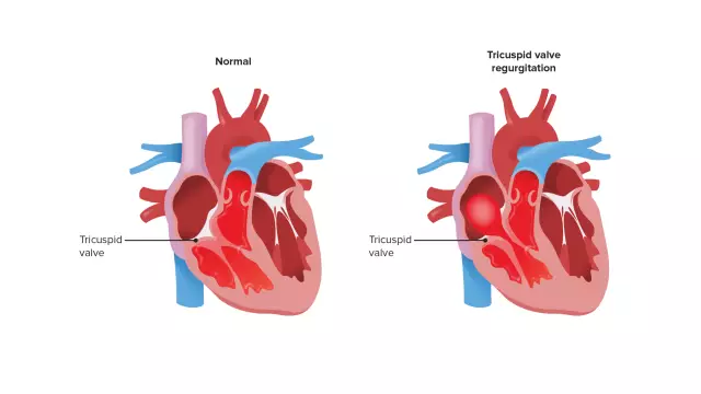 Tricuspid Regurgitation - Degrees And Treatment