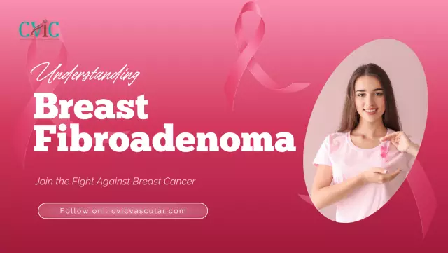 Fibroadenoma - Causes, Symptoms, Diagnosis, Treatment, Removal