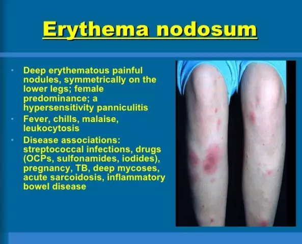 Erythema Nodosum - Symptoms, Causes, Treatment