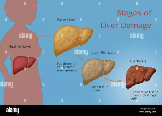 Liver Cirrhosis - Symptoms, Stages, Diagnostic Methods, Treatment