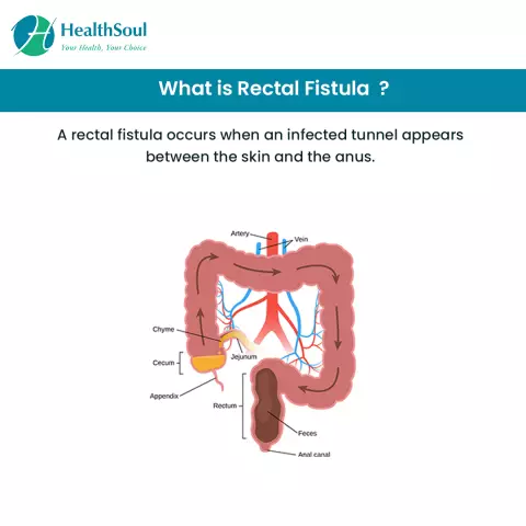 Rectal Fistula - Treatment, Symptoms, Removal