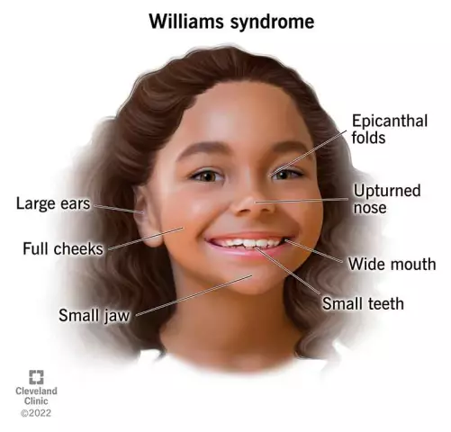 Williams Syndrome - Symptoms, Causes, Treatment