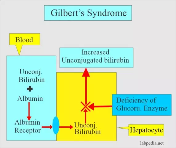 Gilbert's Syndrome - Symptoms, Treatment, Diagnosis