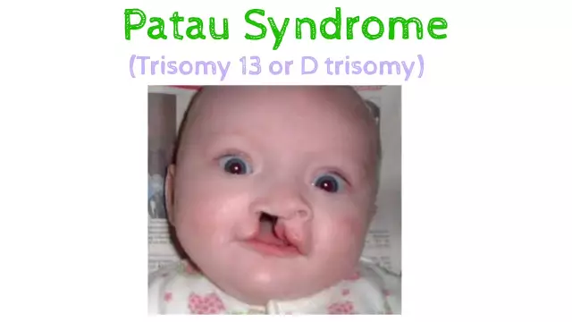 Patau Syndrome - Causes, Symptoms, Treatment