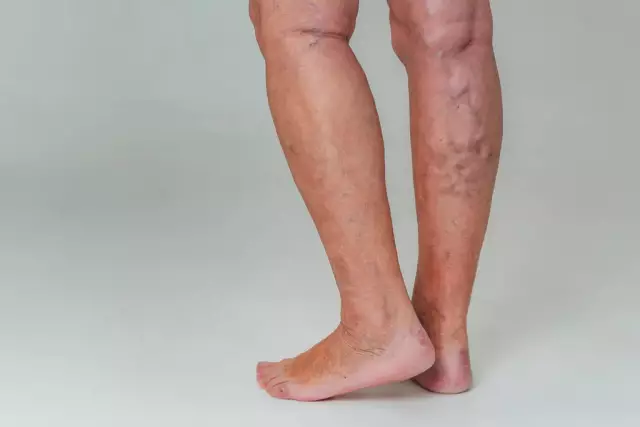 Vascular Insufficiency - Symptoms, Treatment