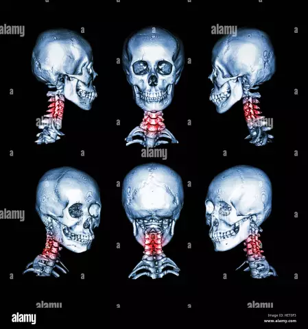 Spondylitis - Types, Symptoms, Treatment