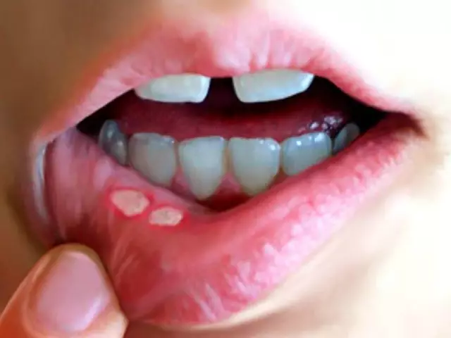 Stomatitis In Children And Adults - Treatment, Symptoms