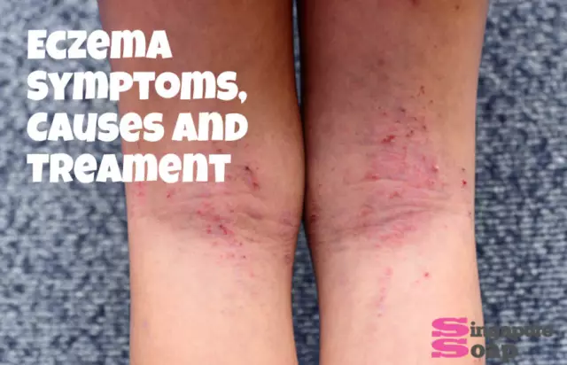 Eczema - Treatment And Symptoms Of The Disease